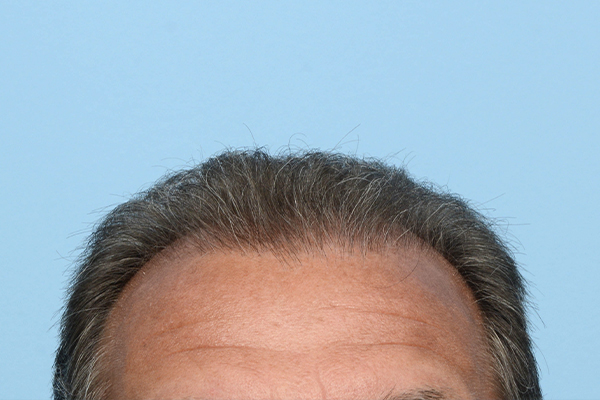 Fue Before and After | Dr. Jeffrey Wise