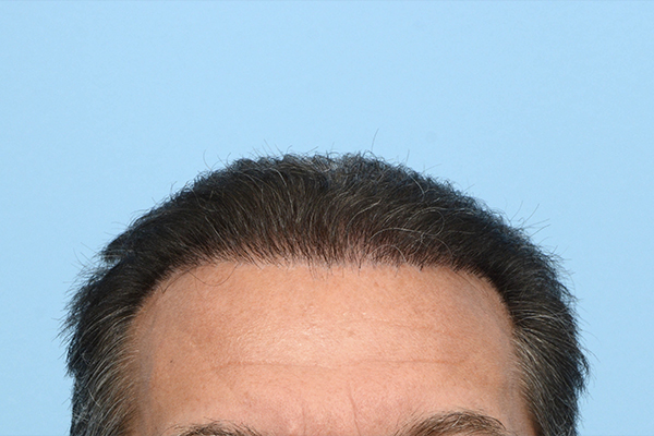 Fue Before and After | Dr. Jeffrey Wise