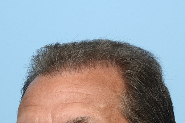 Fue Before and After | Dr. Jeffrey Wise