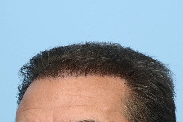 Fue Before and After | Dr. Jeffrey Wise