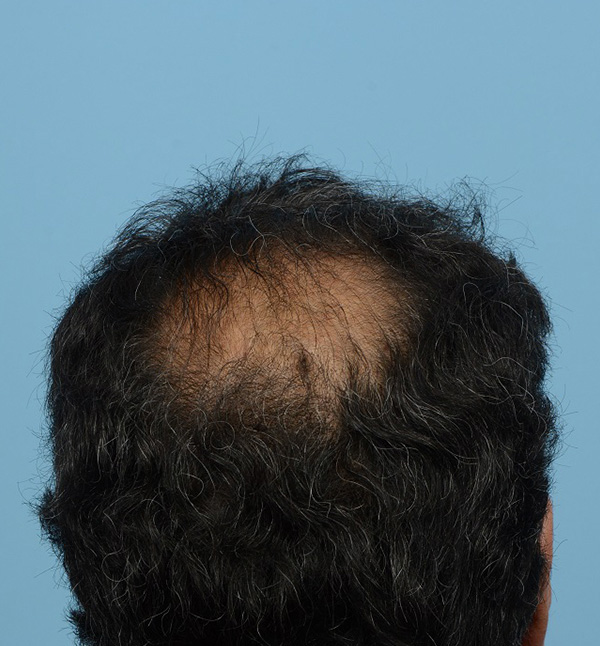 Fue Before and After | Dr. Jeffrey Wise