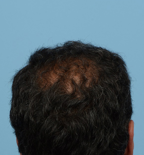 Fue Before and After | Dr. Jeffrey Wise