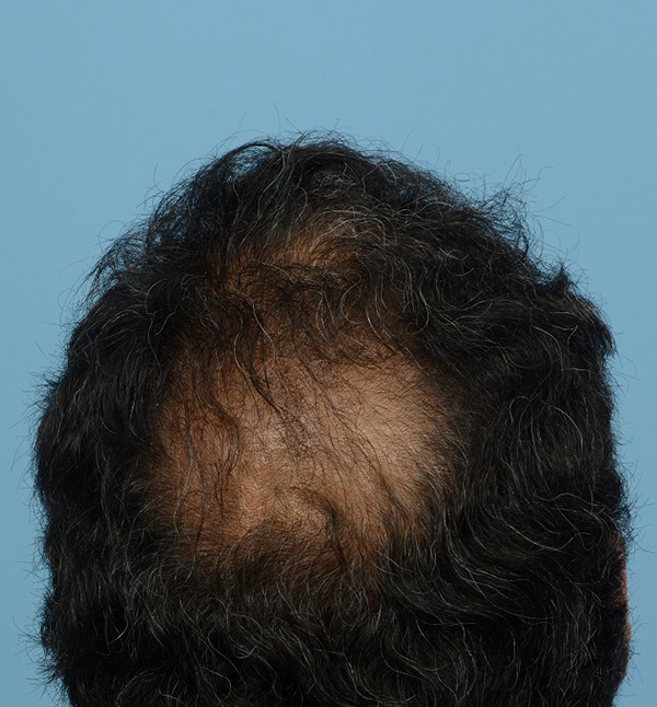 Fue Before and After | Dr. Jeffrey Wise