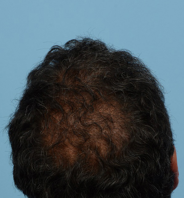 Fue Before and After | Dr. Jeffrey Wise