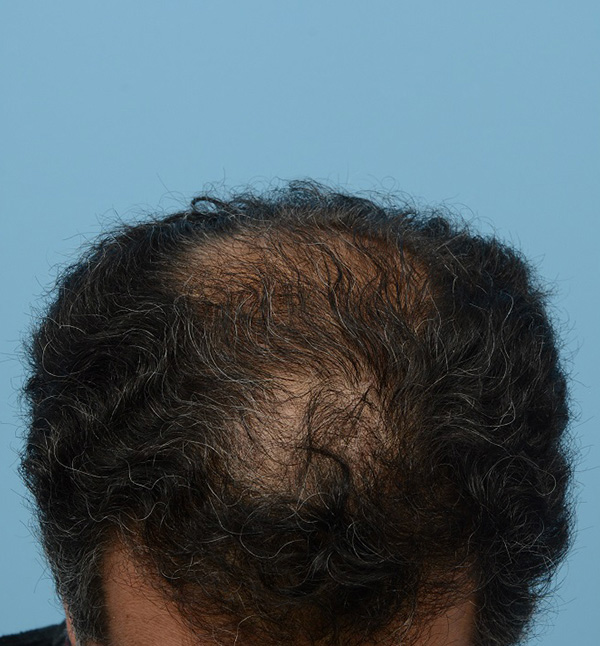 Fue Before and After | Dr. Jeffrey Wise