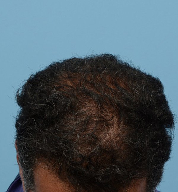 Fue Before and After | Dr. Jeffrey Wise