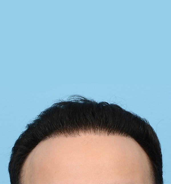 Fue Before and After | Dr. Jeffrey Wise