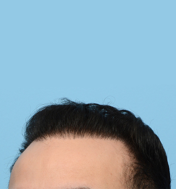 Fue Before and After | Dr. Jeffrey Wise