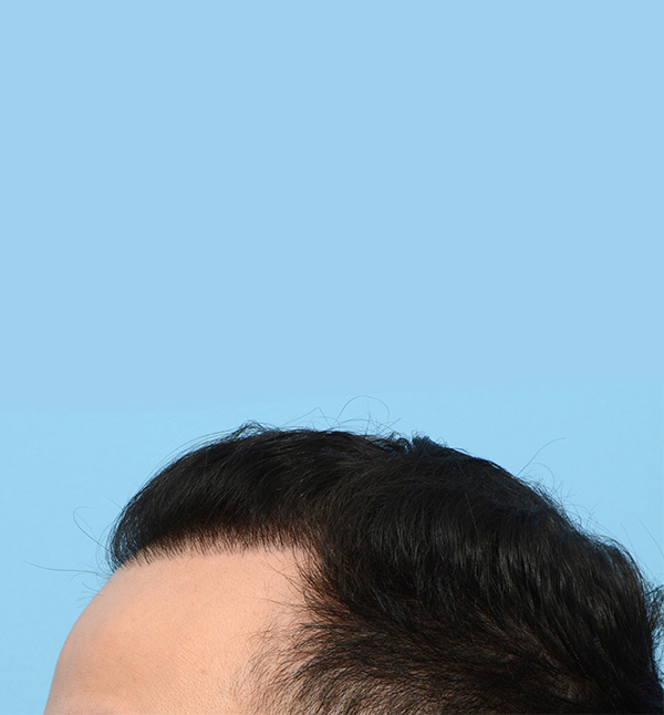 Fue Before and After | Dr. Jeffrey Wise