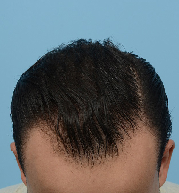 Fue Before and After | Dr. Jeffrey Wise