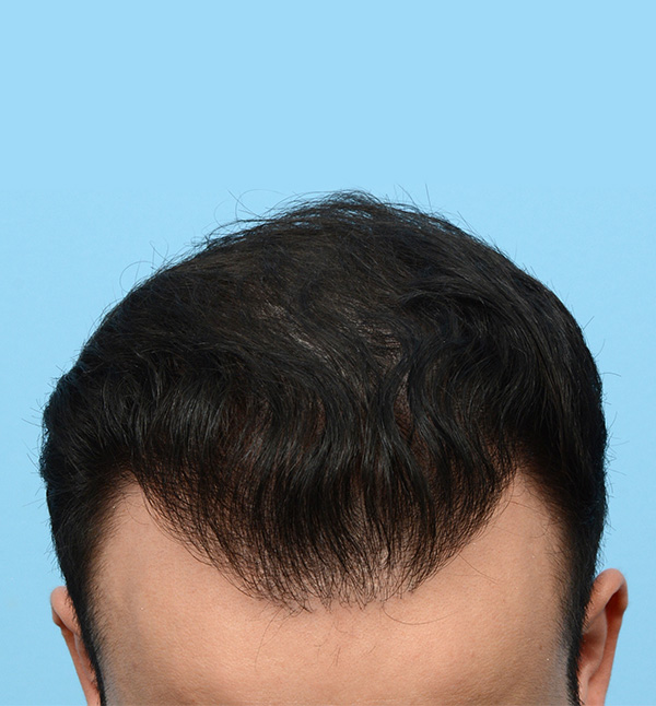 Fue Before and After | Dr. Jeffrey Wise