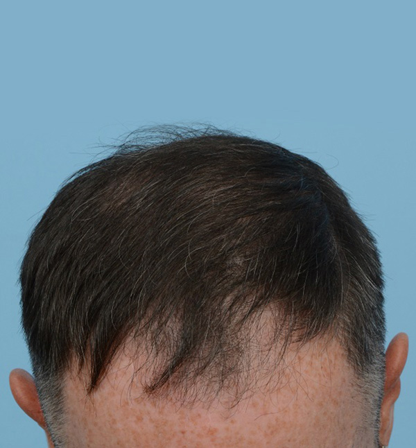 Fue Before and After | Dr. Jeffrey Wise