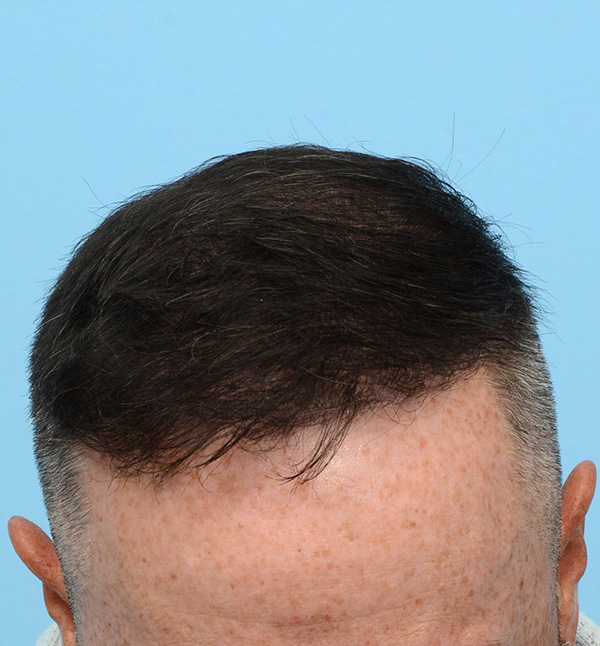 Fue Before and After | Dr. Jeffrey Wise