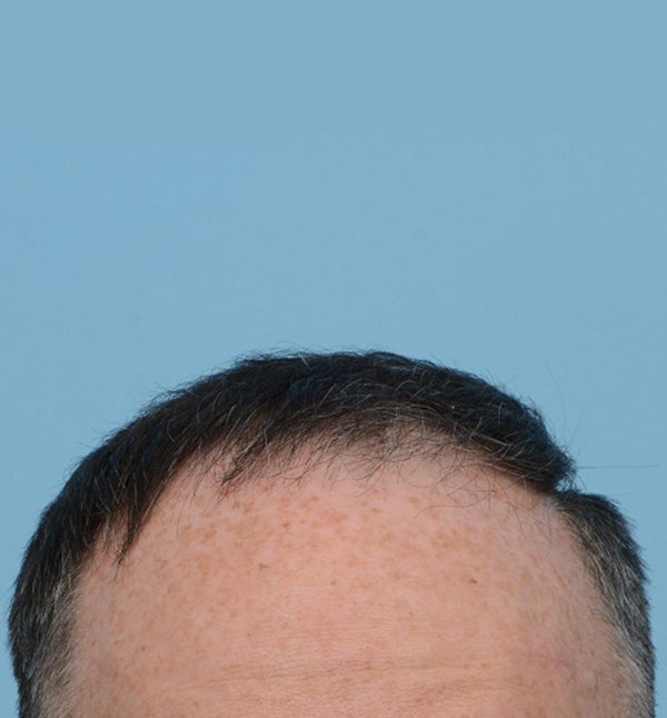 Fue Before and After | Dr. Jeffrey Wise