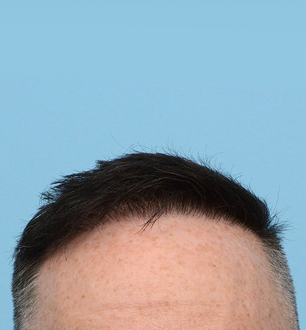 Fue Before and After | Dr. Jeffrey Wise