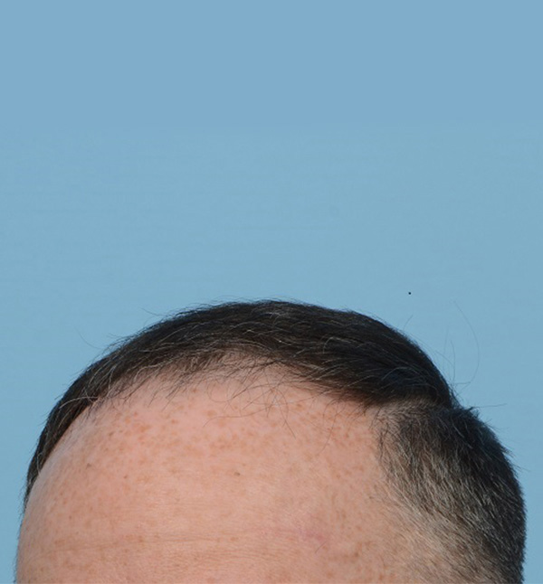 Fue Before and After | Dr. Jeffrey Wise