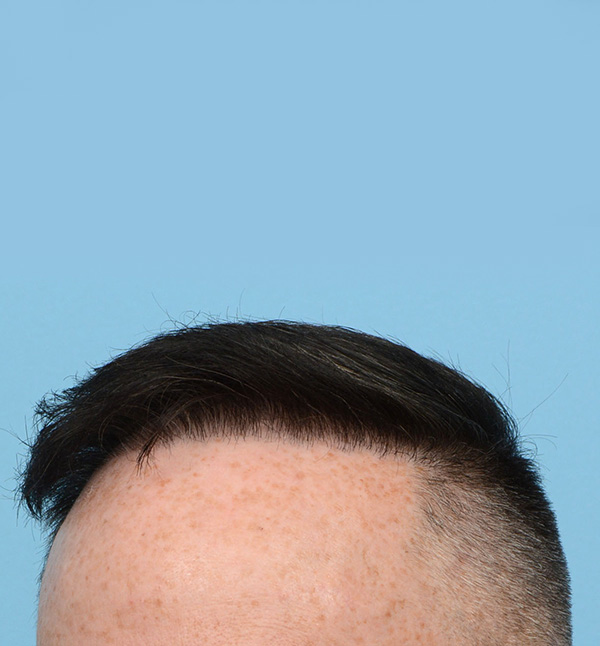 Fue Before and After | Dr. Jeffrey Wise