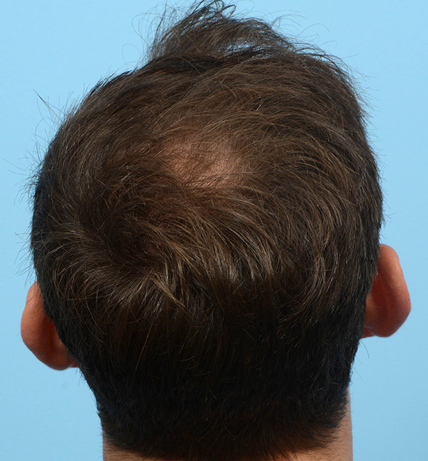 Fue Before and After | Dr. Jeffrey Wise