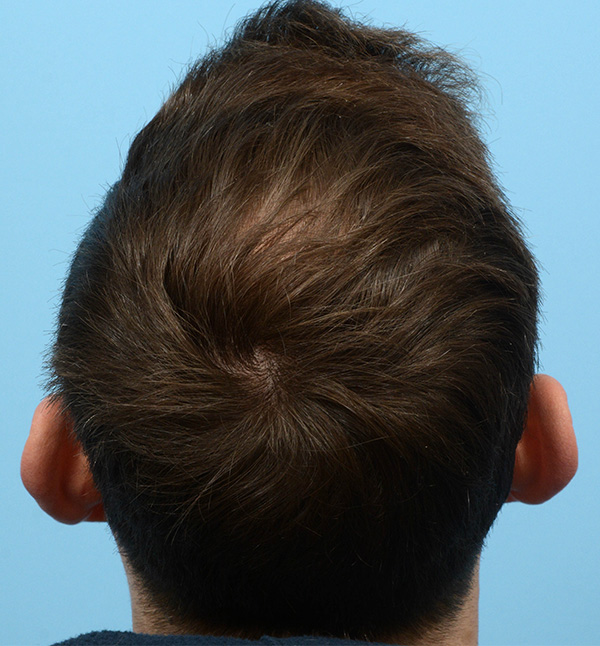 Fue Before and After | Dr. Jeffrey Wise