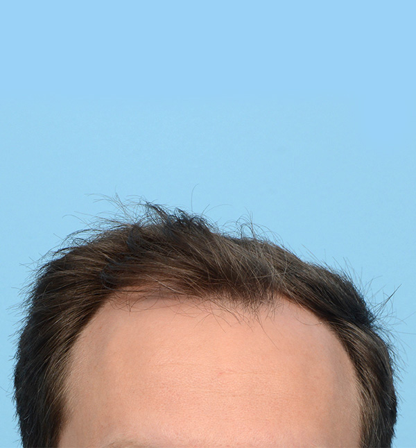 Fue Before and After | Dr. Jeffrey Wise