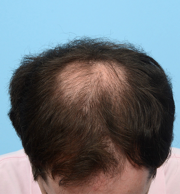 Fue Before and After | Dr. Jeffrey Wise