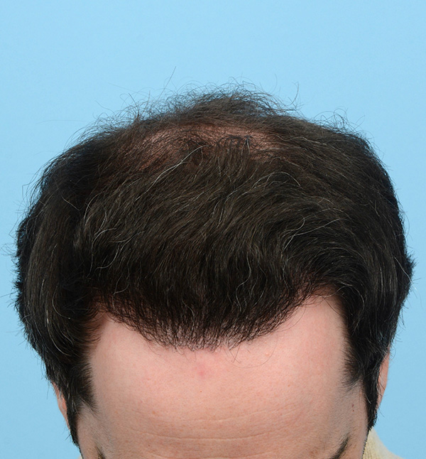 Fue Before and After | Dr. Jeffrey Wise