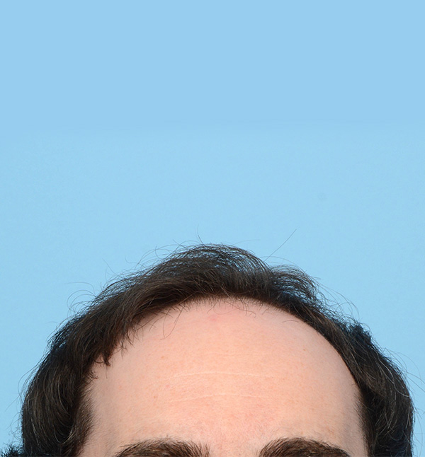 Fue Before and After | Dr. Jeffrey Wise