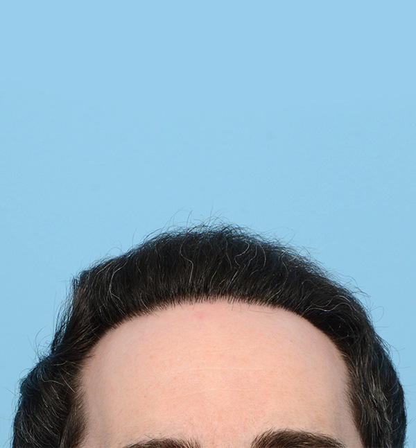 Fue Before and After | Dr. Jeffrey Wise