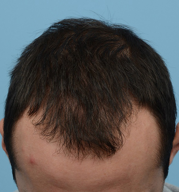 Fue Before and After | Dr. Jeffrey Wise