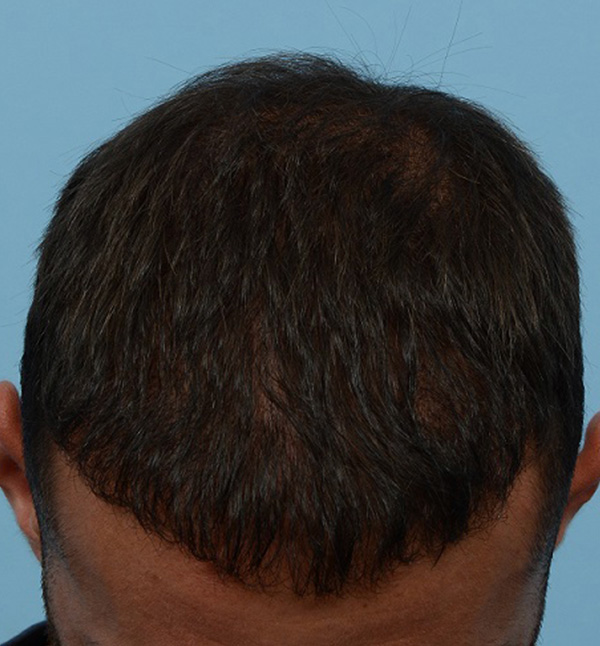 Fue Before and After | Dr. Jeffrey Wise