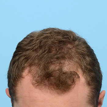 Fue Before and After | Dr. Jeffrey Wise