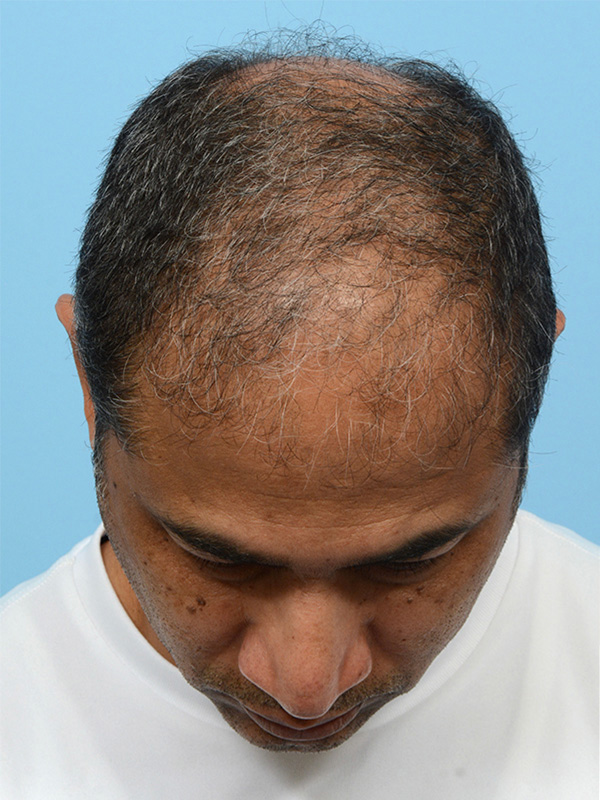 Fue Before and After | Dr. Jeffrey Wise