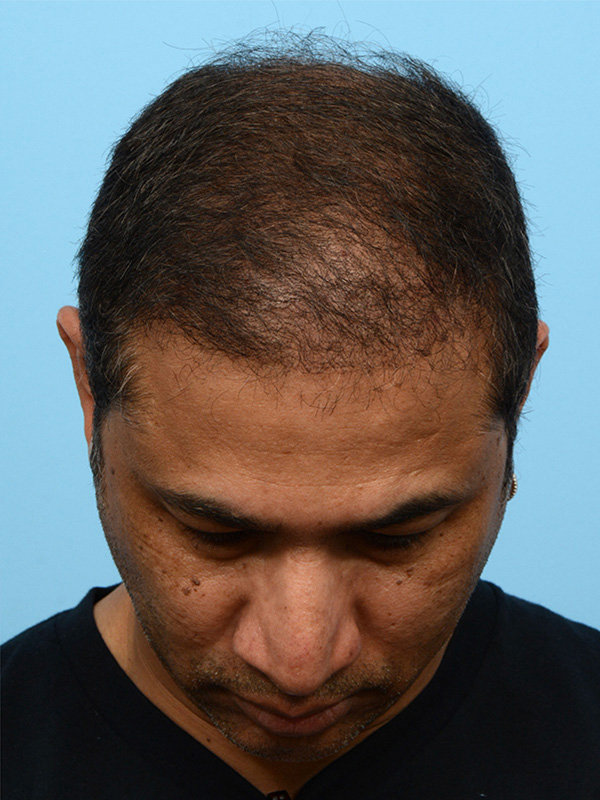 Fue Before and After | Dr. Jeffrey Wise