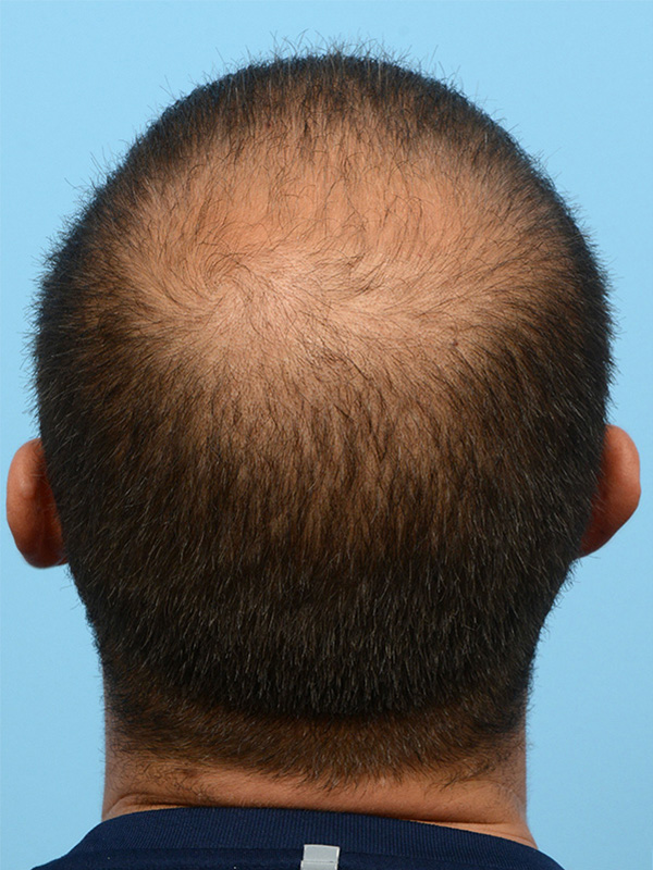 Fue Before and After | Dr. Jeffrey Wise