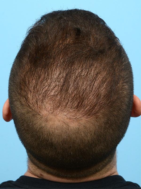 Fue Before and After | Dr. Jeffrey Wise