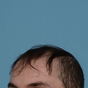 Fue Before and After | Dr. Jeffrey Wise