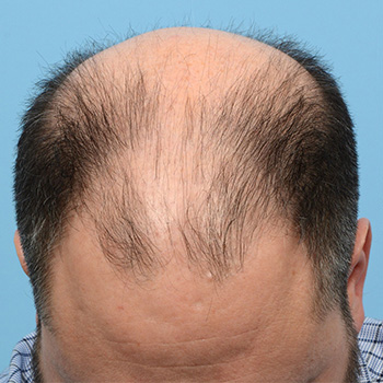 Fue Before and After | Dr. Jeffrey Wise