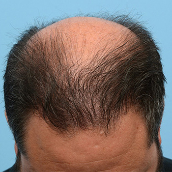 Fue Before and After | Dr. Jeffrey Wise