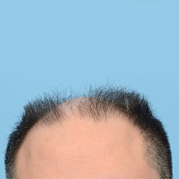 Fue Before and After | Dr. Jeffrey Wise