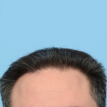 Fue Before and After | Dr. Jeffrey Wise