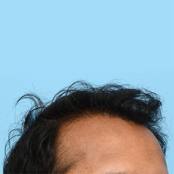 Fue Before and After | Dr. Jeffrey Wise