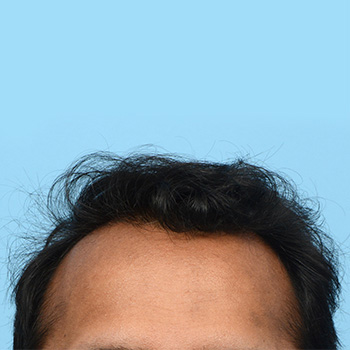 Fue Before and After | Dr. Jeffrey Wise