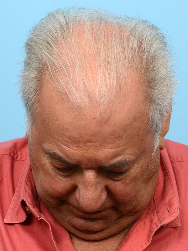 Fue Before and After | Dr. Jeffrey Wise