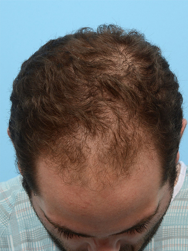 Fue Before and After | Dr. Jeffrey Wise