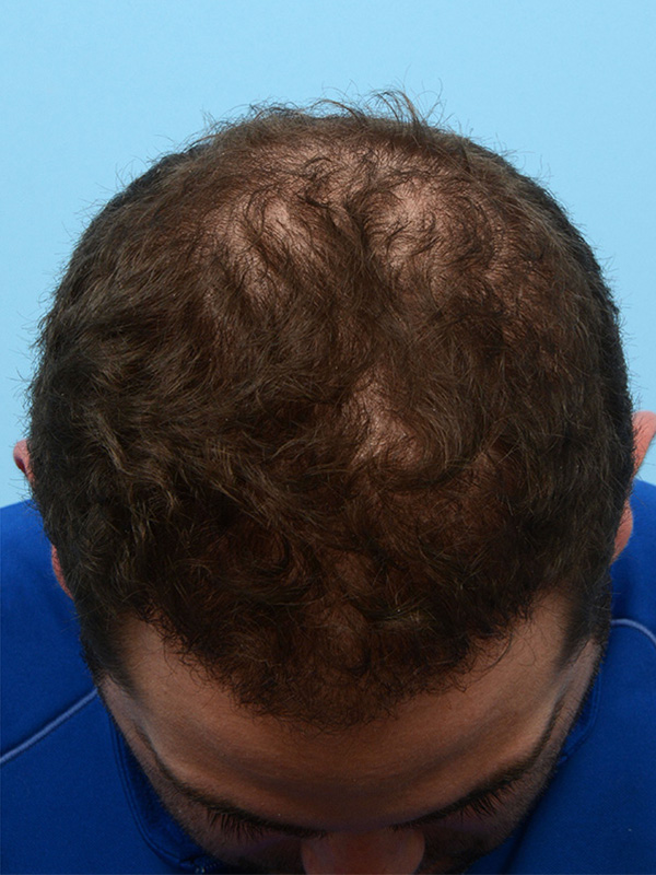 Fue Before and After | Dr. Jeffrey Wise