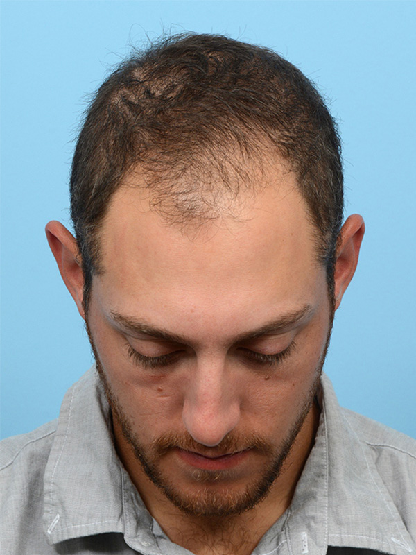 Fue Before and After | Dr. Jeffrey Wise