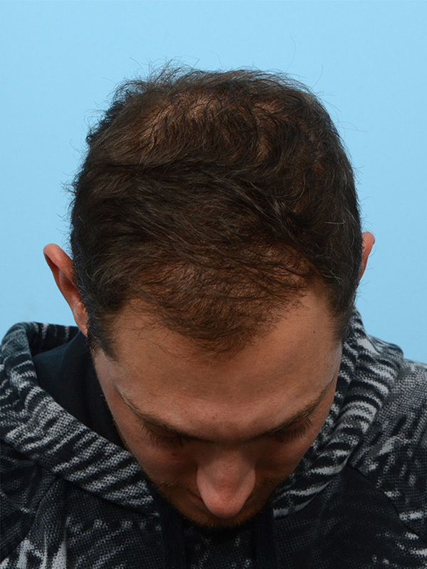 Fue Before and After | Dr. Jeffrey Wise