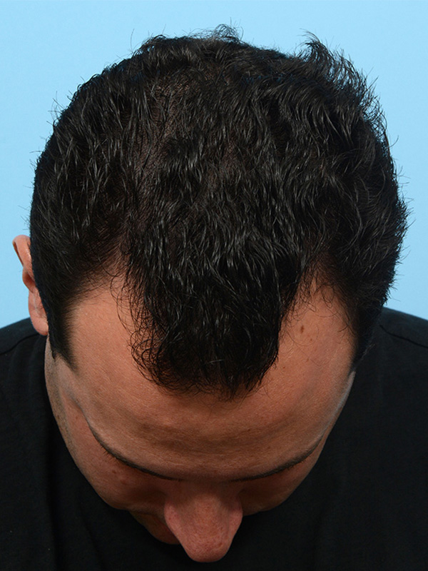 Fue Before and After | Dr. Jeffrey Wise