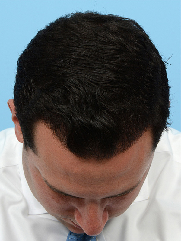 Fue Before and After | Dr. Jeffrey Wise