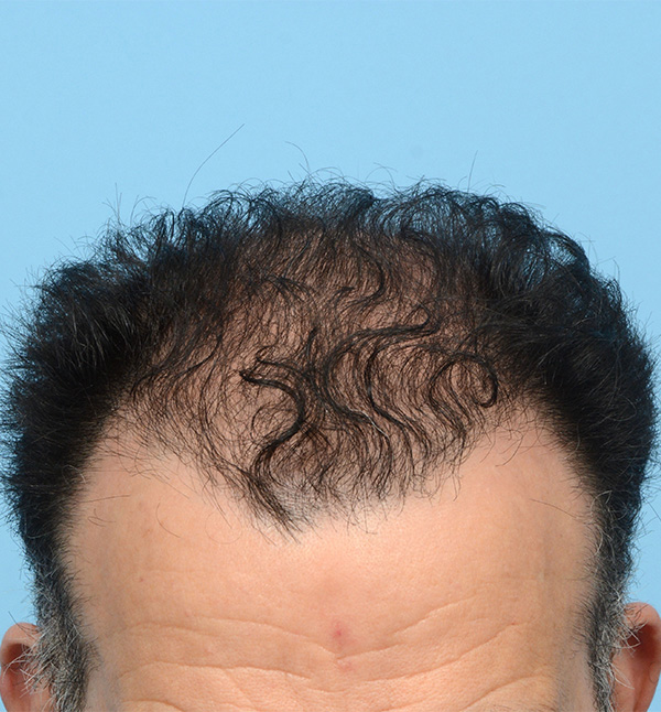 Fue Before and After | Dr. Jeffrey Wise